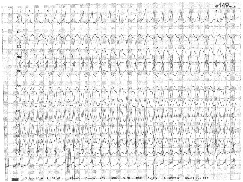 Acute Vertigo, Dizziness and Imbalance in the Emergency Department-Beyond Stroke and Acute Unilateral Vestibulopathy-A Narrative Review.