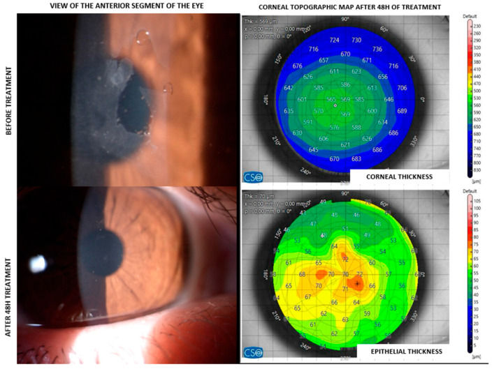 Cross-Linked Carboxymethyl Cellulose and Silk Proteins in Corneal Re-Epithelialization: A Case Series.