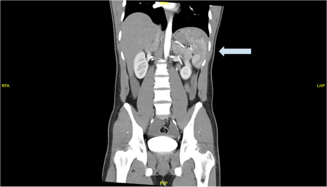 A unique case of atraumatic splenic haematoma likely caused by increased intra-abdominal pressure: a case report.