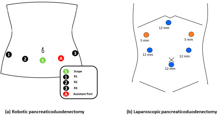 Textbook Outcomes of Totally Robotic Versus Totally Laparoscopic Pancreaticoduodenectomy for Periampullary Neoplasm: A Propensity Score-Matched Cohort Study.