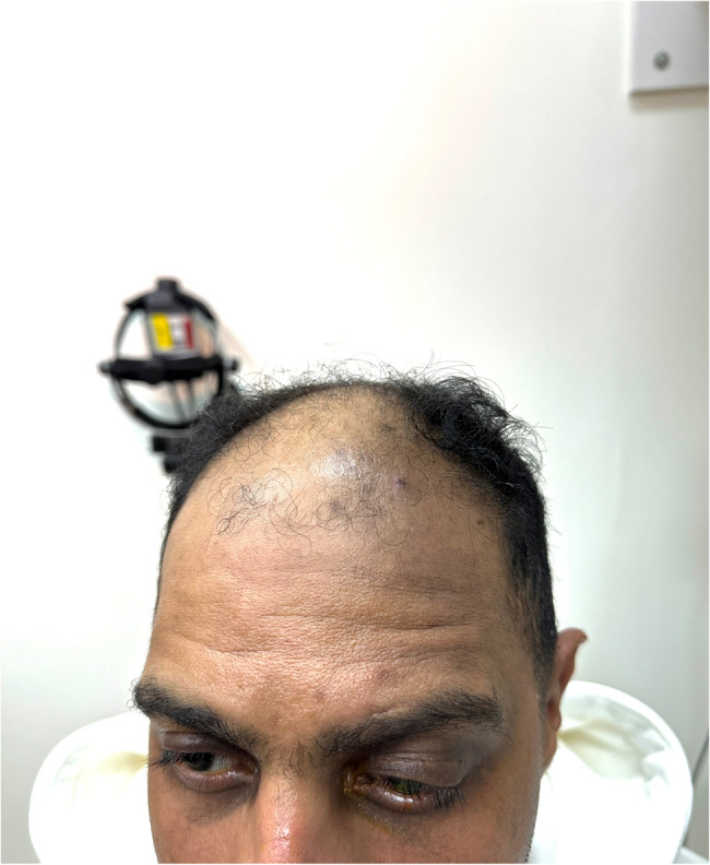 Post-corneal tattooing trigeminal nerve-distributed hyperpigmentation: a case report.