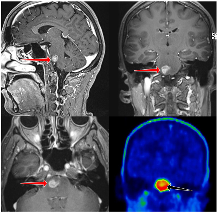 Brainstem Glioma Prognostication: Static FET PET/CT.