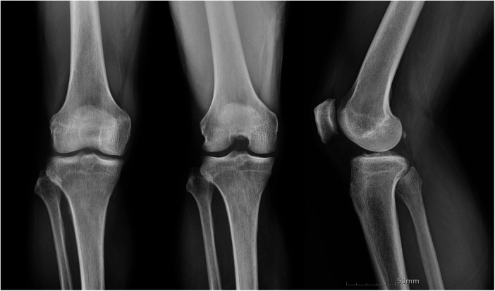 Case Report: Simultaneous mucoid degeneration of the ACL and PCL in a 62-year-old man: an under-recognized diagnostic pitfall.