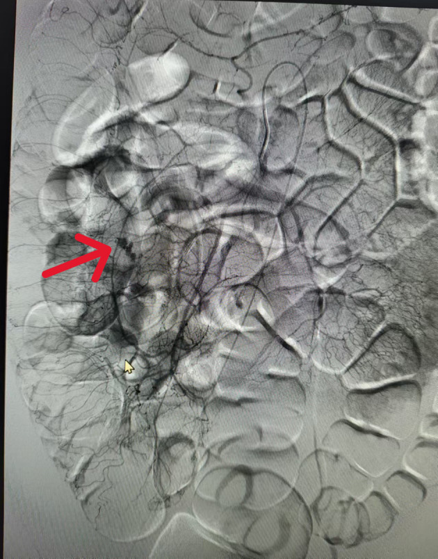 Massive Gastrointestinal Hemorrhage in an Adult Caused by Meckel's Diverticulum: A Case Report.