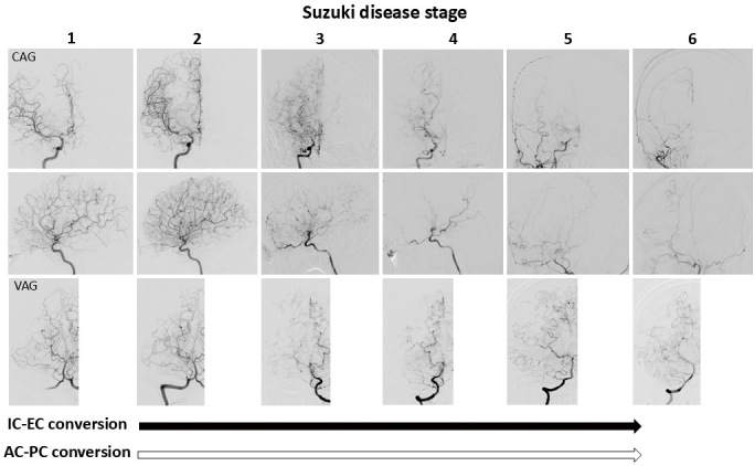 Incidence and Clinical Characteristics of Moyamoya Disease in Advanced Suzuki Disease Stages.