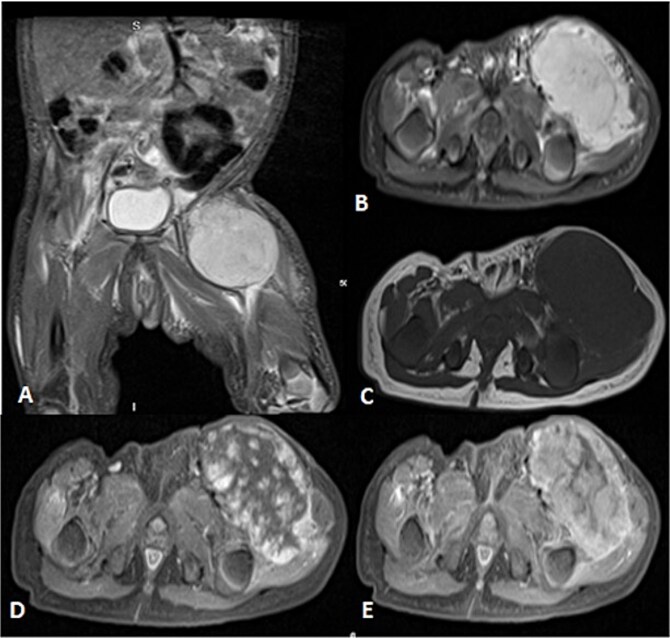 Is it a hemangioma? A combined case report of soft tissue sarcomas mimicking infantile hemangioma.