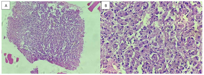 Multiple paragangliomas diagnosed in head, neck, and mediastinum: a case report.
