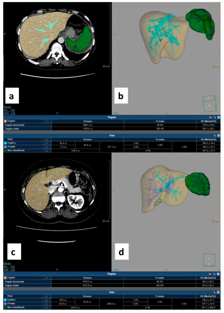 Medium- and Long-Term Evaluation of Splenic Arterial Embolization: A Retrospective CT Volumetric and Hematologic Function Analysis.