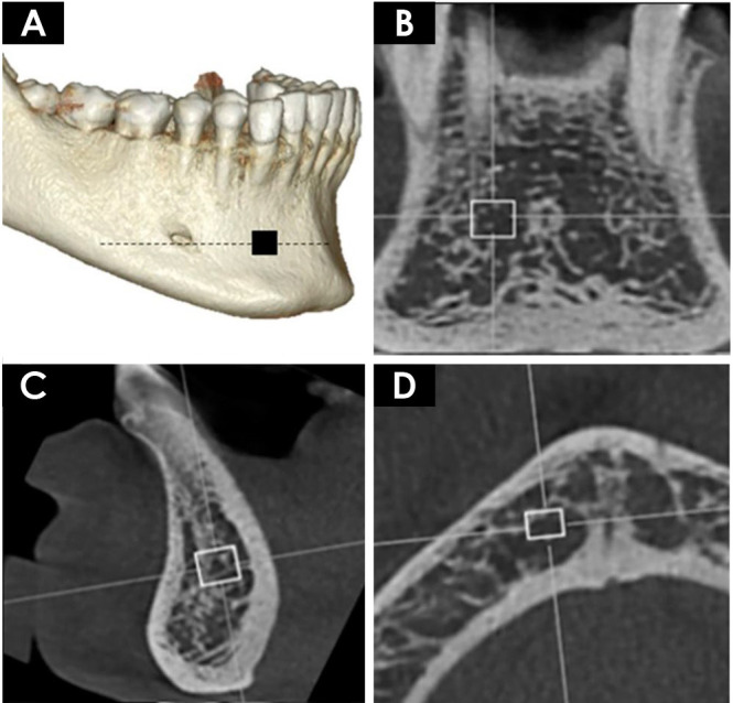 Influence of cone-beam computed tomography reconstruction parameters on bone fractal dimension: A cross-sectional observational study.