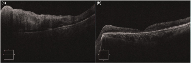 Neovascular glaucoma associated with central retinal vein occlusion in a young patient with hyperlipidemia.