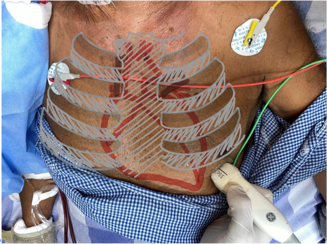 Right ventricular dysfunction: a key predictor of post-intubation hypotension in the emergency department.