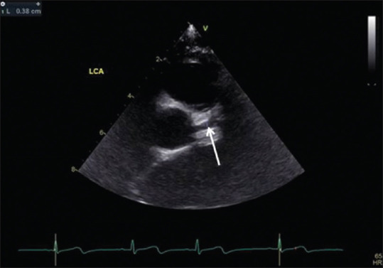 Echocardiographic Evaluation in Kawasaki Disease.