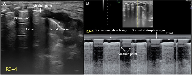 Case Report: Air-fluid point: a specific ultrasound sign for the diagnosis of hydropneumothorax in newborn infants.