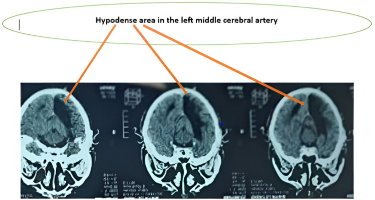 A Rare Case of Ischemic Stroke Secondary to Polycythemia with Rapid Resolution After Phlebotomy.