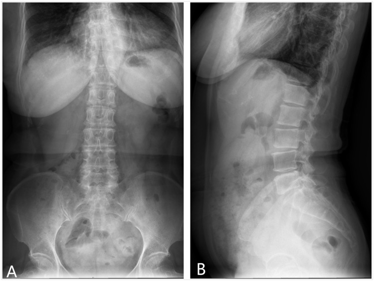 Treatment of Painful One Level Schmorl's Nodes Using Percutaneous Endoscopic Lumbar Discectomy: A Clinical Evaluation.