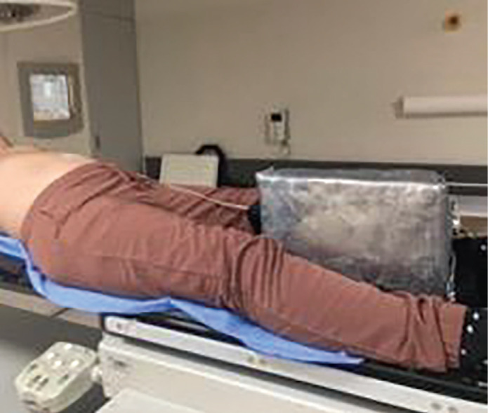 Safe Delivery of Radiotherapy for Breast Cancer Patient With Left Ventricular Assist Device: Case Report and Review of the Literature.