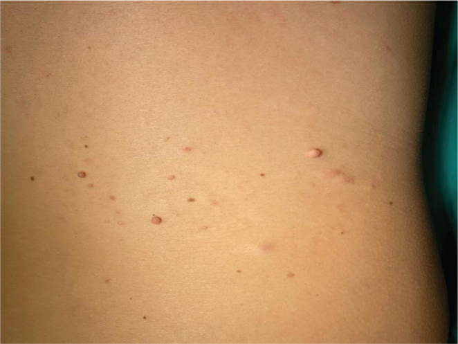 Multiple Papules and Nodules in a Dermatomal Distribution: A Quiz.
