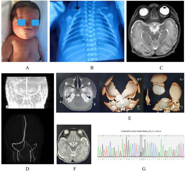 A Chinese premature infant with cleidocranial dysplasia characterized by heterozygous RUNX2 mutation and cerebral infarction: a case report.