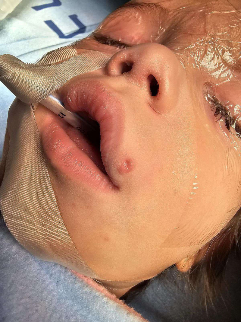Congenital Lateral Upper Lip Sinus: A Review of the Literature.