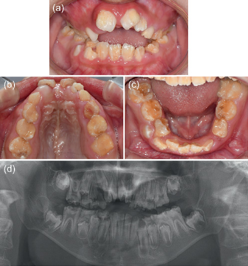 Unique Dental and Craniofacial Manifestations of Hypoplastic Amelogenesis Imperfecta in a Patient With Prune Belly Syndrome: A Rare Case Report.