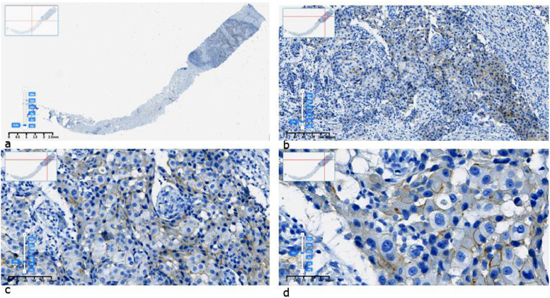 Kazakhstani HER2 breast cancer digital image dataset: The ADEL dataset.