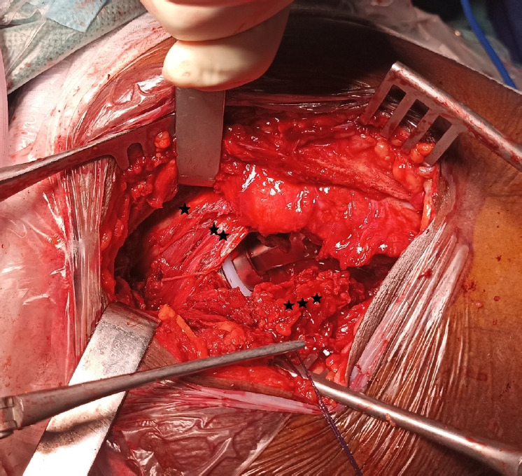 The SPAIRE (saving piriformis and internus, repair of externus) posterolateral approach in bipolar hemiarthroplasty for femoral neck fractures: a case report.
