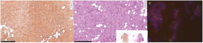 Dermatofibrosarcoma Protuberans of the Breast.