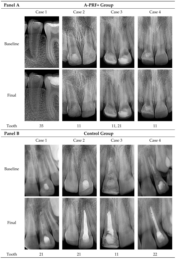 Advanced Platelet-Rich Fibrin Plus Sealed Exclusively with Glass Ionomer Cement: Setting a New Standard for Healing, Aesthetics and Predictive Modelling in Regenerative Endodontics.