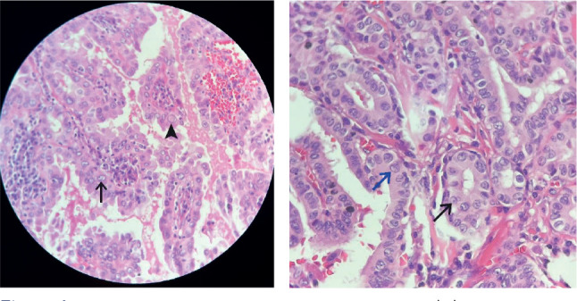 In suspicious for malignancy thyroid nodule aspirates, nuclei characteristics deserves special attention in reported cytology analysis - real world scenario cohort.