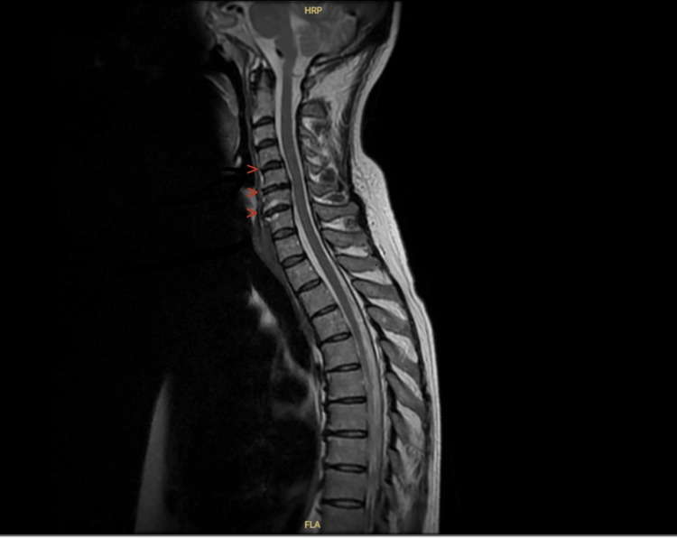 Mononeuritis Multiplex as a Diagnostic Challenge in Eosinophilic Granulomatosis With Polyangiitis: Implications of Early Versus Delayed Recognition.