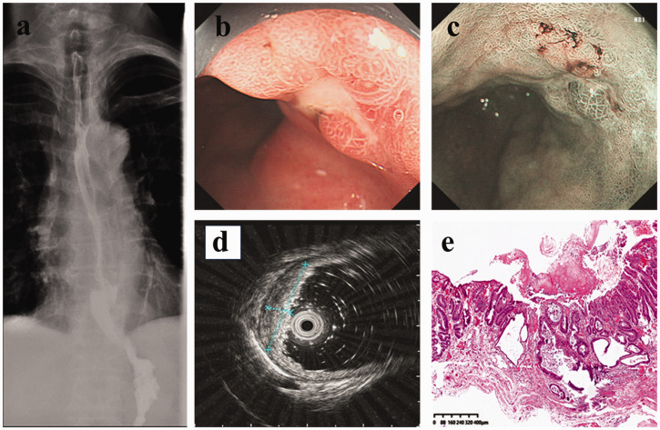 Sponge cytology combined with endoscopy in patients with long-segment Barrett's esophagus: A retrospective case series and literature review.