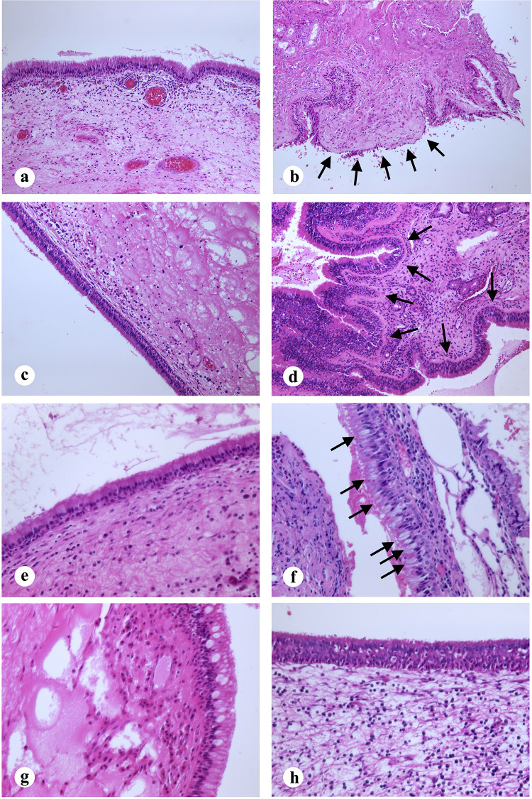 Histopathological Characteristics of Nasal Tissues From Paediatric Patients with Chronic Rhinosinusitis and Nasal Polyps Requiring Revision Surgery.