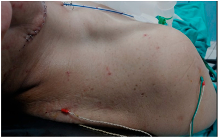 Motor Innervation of the Trapezius by Cervical Sensitive Nerves: An Intraoperative Neuromonitoring Study and Postoperative Functional Outcomes.