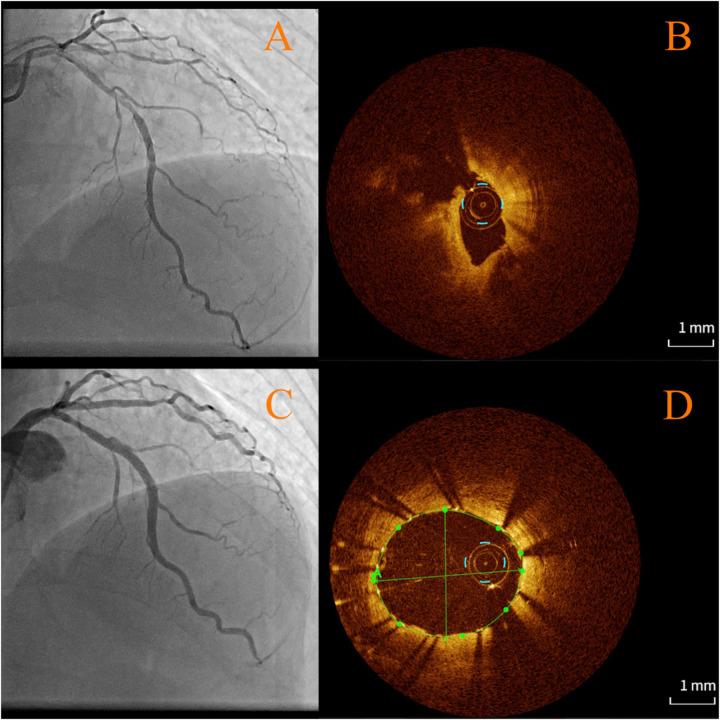 Case Report: Coronary plaque rupture following glucocorticoid tapering in a high-risk CAD patient with immune nephritis: mechanistic insights and clinical implications.