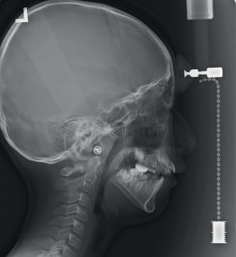 Unique Dental and Craniofacial Manifestations of Hypoplastic Amelogenesis Imperfecta in a Patient With Prune Belly Syndrome: A Rare Case Report.