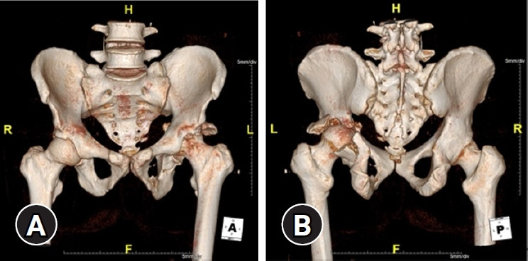 Preperitoneal pelvic packing as a salvage operation for postoperative retroperitoneal bleeding with hemodynamic instability after the Kocher-Langenbeck approach to the acetabulum: a case report.