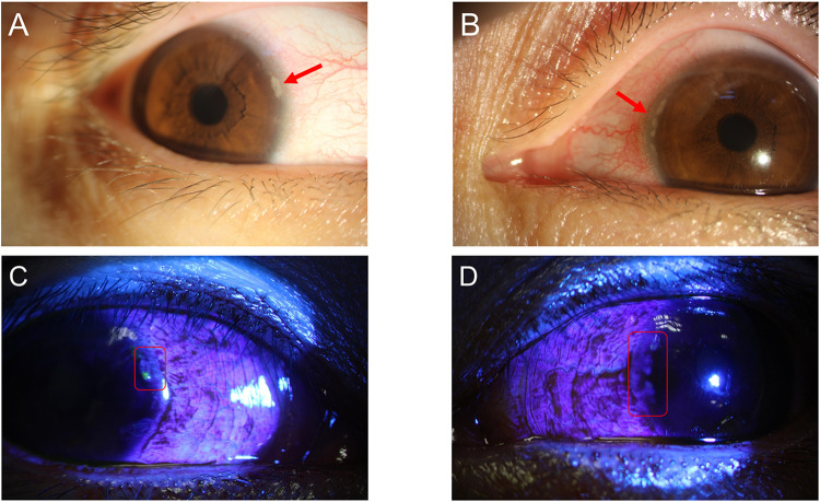 Immune-Related Peripheral Keratopathy in Post-COVID-19 Syndrome.
