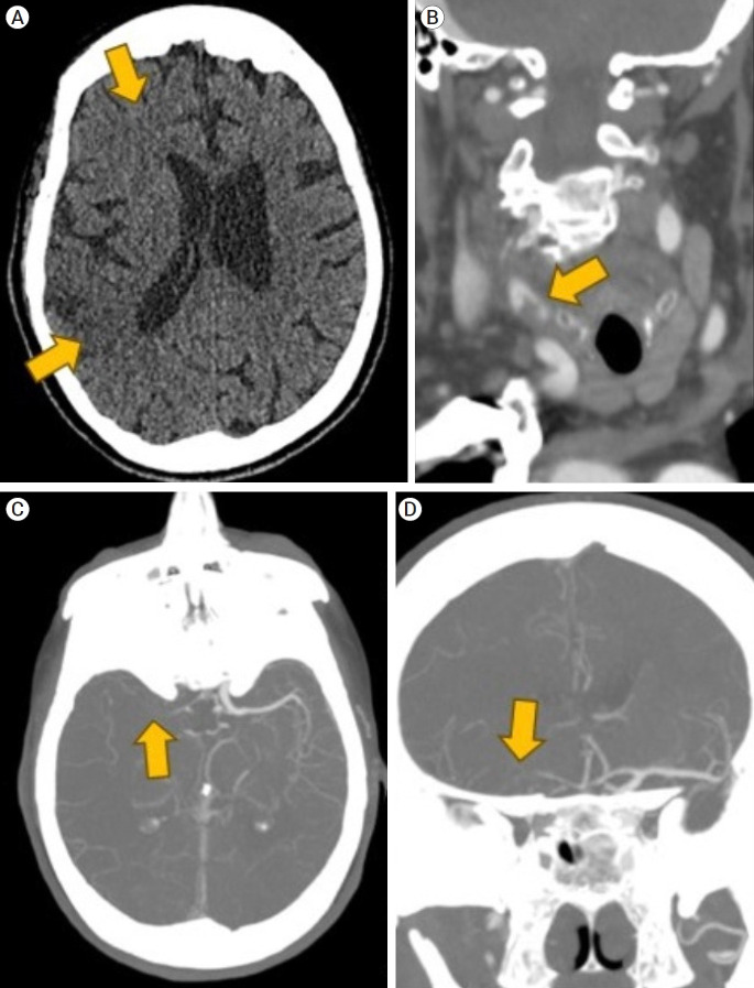 Navigating severe vascular tortuosity and cervical carotid loop management in stroke thrombectomy: A case report and review of the literature.