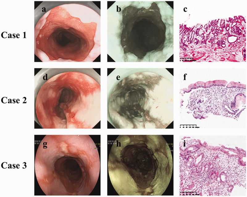 Sponge cytology combined with endoscopy in patients with long-segment Barrett's esophagus: A retrospective case series and literature review.