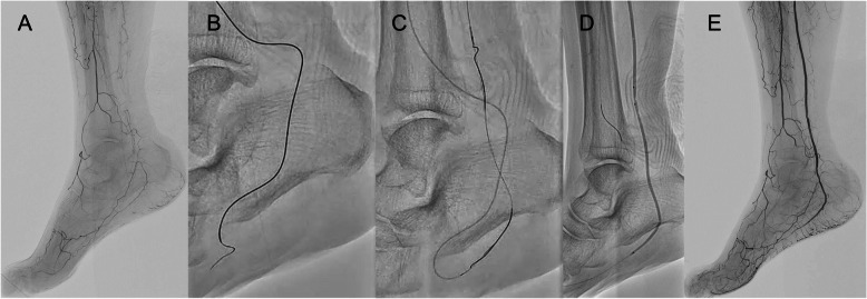 Efficacy and safety of Trans-collateral revascularization of infrapopliteal vessels: A Single-center retrospective study.