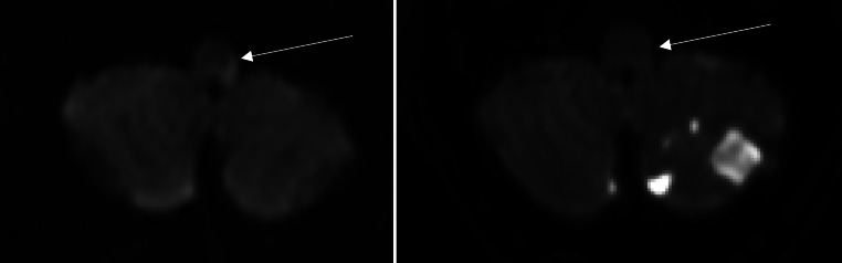 DWI Reversibility in Acute Ischemic Stroke Due to Basilar Artery Occlusion Following Successful Recanalization.