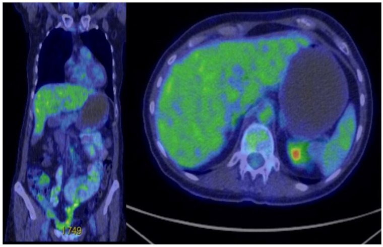 The Role of Targeted Therapy and Immunotherapy in Metastatic GNET/Clear Cell Sarcoma (CCS) of the Gastrointestinal Tract: A Case Report.