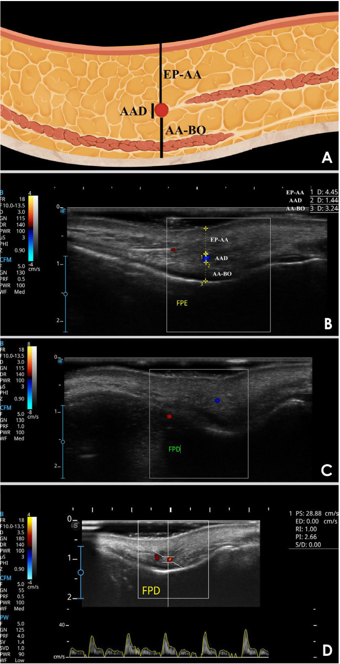 Depth and hemodynamics of the angular artery in the pyriform space: A cross-sectional study with Doppler ultrasonography.