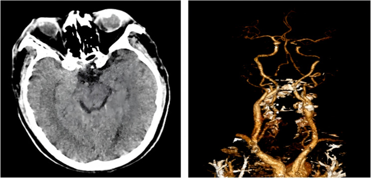 A rare coincidence of presentation of TIA like illness immediately followed by acute myocardial infarction and cardiac arrest: a case report.