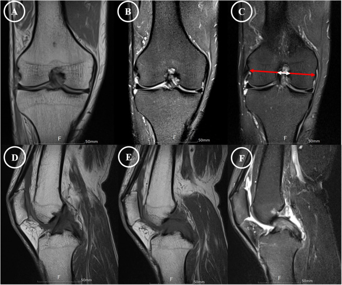 Case Report: Simultaneous mucoid degeneration of the ACL and PCL in a 62-year-old man: an under-recognized diagnostic pitfall.