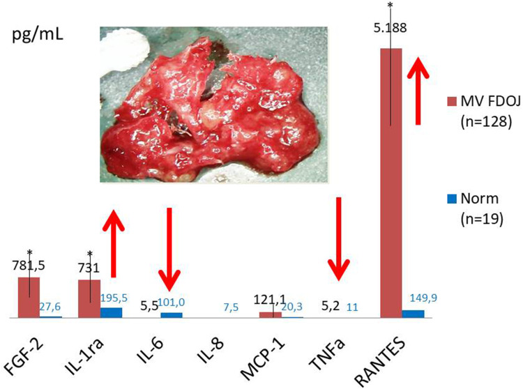 Could Silent Inflammation Originating in Jawbone Cavitations Play a Role in Activating the CCL5/CCR5 Axis in Female Breast Cancer? A Diagnostic and Therapeutic Gap in Osteoimmunological Interactions.