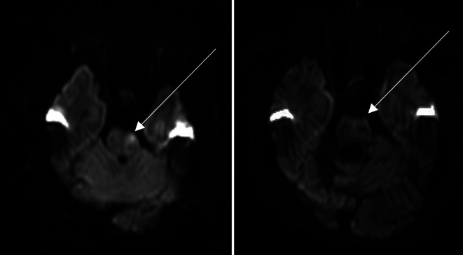 DWI Reversibility in Acute Ischemic Stroke Due to Basilar Artery Occlusion Following Successful Recanalization.