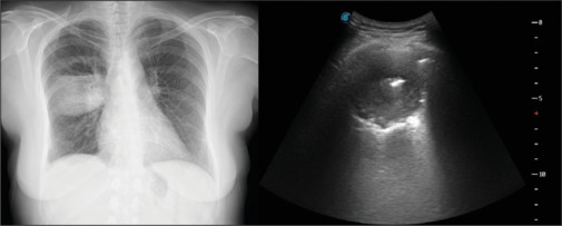 Thoracic ultrasonography in the diagnosis and follow-up of lung abscess.
