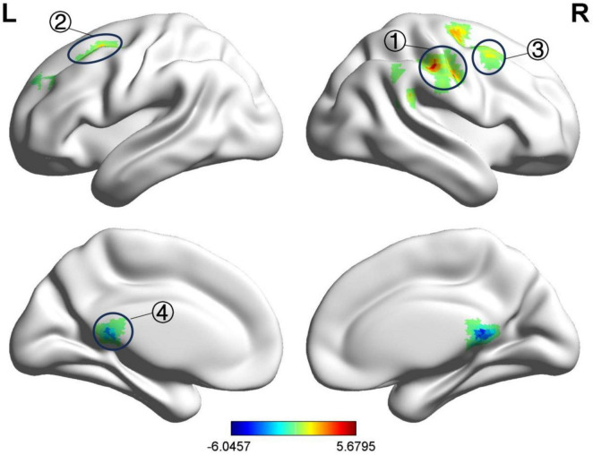 Exploring the potential central regulatory mechanisms of acupuncture for acute-stage Bell's palsy: an fMRI-based investigation.