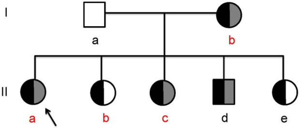 Case Report: a family report of hereditary pancreatitis caused by SPINK1 and PRSS1 gene mutations.